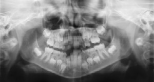 Pediatric Dentist - Dental Radiographs (X-Rays)